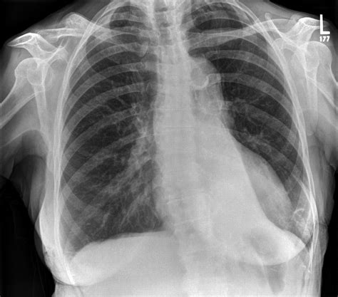 can chest xray show asthma|Chest X.